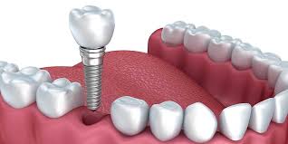 Best Dental Implant Surgeon